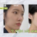 더예쁜성형외과의원 | 무드온성형외과 코재수술+지방이식 브이로그📺 (당일~한달차)