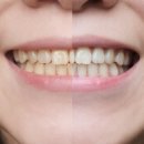 명기약국 | 치아미백제 추천, 브리올 셀프치아미백제 2주 사용 솔직후기