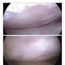 [조선일보] 제대혈 줄기세포 치료로 소실된 연골까지 재생시켜-선정형외과 이미지
