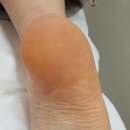 나도손톱 레푸스 개봉점 이미지