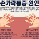 손가락 조조 강직 증상 원인 완화 방법 이미지