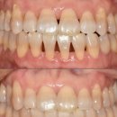 신서밝은미소치과의원 | 강남치과 무삭제라미네이트로 잇몸사이 공간 매꾸기