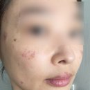 창원 | 창원 흑자제거 내돈내산 후기 | 창원한의원 기미제거