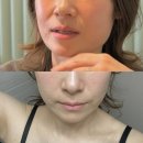 땅콩이네 | 옆볼패임 팔자 필러보다 볼패임 쥬베룩 땅콩주사 효과 후기