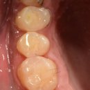 디어스치과의원 | 강동구 천호동치과 어금니 발치 후 흡연, 한 대만 피워도 문제될까?