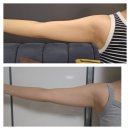 수성레이저 | 대구수성구피부과 온다레이저후기 6만줄