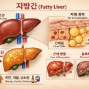 지방간의 진단과 관리 | 건강검진 지방간 판정 후 꼭 알아야 할 치료방법