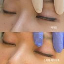 뷰티미담 | 창원 아이라인제거 미담뷰티 3회차 후기 제거 전후 사진비교