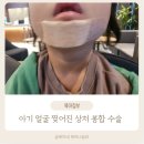 서초 서울 마더스 | 아기 얼굴 찢어진 상처, 서울마더스성형외과에서 봉합 수술 후기