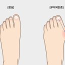 [남부터미널PT, 교대PT] 무지외반증 교정운동