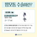 잠실 맘모톰 수술 후기, 통증 관리 비법은?