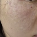 동성로스킨보톡스 후기 눈가 탄력 눈밑 주름 개선 경과 솔직 리뷰 _5주차
