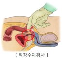 치질검사 방법 이미지