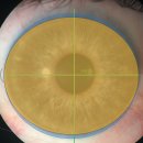 강막렌즈 피팅 마스터링: 5,000명의 환자로부터 얻은 교훈 이미지