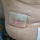 용 암 | 담도암 수술 퇴원 후 2주 후기 (당뇨와의 전쟁)