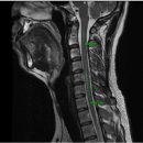 안녕하세요, 척수 공동증에 대해 문의드려요 이미지