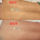 옷미인 | 건대 자연 미인 에스테틱 피부관리 문제성 피부 여드름 트러블 임상 후기!