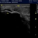 Rupture within Achilles Tendon 이미지