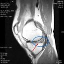 무릎연골'무릎통증의 원인 연골판파열 이미지