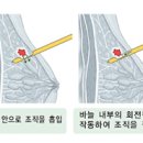 유방암의 일반적 증상 이미지