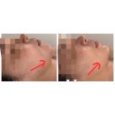 4471 | 두정동리프팅 에버림에스테틱 싸이블로 후기 통증없이 1회 효과