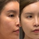 알파평촌역 | 안양리프팅 평촌역 3분거리 덴서티알파 600샷, 효과 통증까지 리얼후기 남겨봄