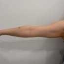 셀바디 | 천안전신관리 수봄에스테틱, 울트라 셀 바디컨투어 팔뚝살 후기!