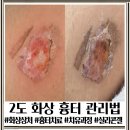새그린약국 | [화상 후기 2탄] 2도 화상 흉터 관리법: 실리콘 젤 사용 시기부터 흉터 예방 꿀팁까지!