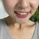 대구치아미백 달서구치과 치아미백후기