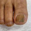 균스포츠 | 양재 내성발톱 관리 스포츠댄스용 구두 때문에 변형된 사례 케어 후기