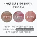 입주변 피부염 계속 가려움 원인 대체 뭘까요 이미지