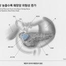 &#34;당뇨병 없어도 공복 혈당 높으면 췌장암 위험 증가&#34; 이미지