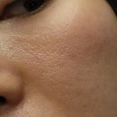 톡스미의원 | 모공부자 스킨보톡스 더마톡신 후기 내돈내산 (feat.예비신부)