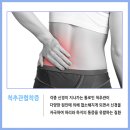 강남구 허리교정 # 척추관협착증은 왜 생길까? 이미지