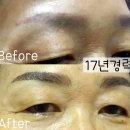 더블류성형외과 네이버블로그