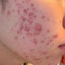 해초랑 | (실사후기) 마리브 해초크림 후코테놀 여드름 실사용 병행 장단점