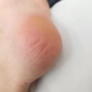 더타이어샵 용인중앙점 | 『용인』레푸스 용인중앙점 - 발바닥 각질관리 리얼 후기 , 발 각질 심한 분 필수!!