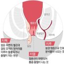 서울진외과의원 | 외치핵 연고 효과 없어서 바로 치핵 수술행 [서울진외과 치질수술한달후기]