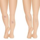 하지정맥류의 치료와 예방 이미지