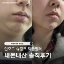 일치성형외과의원 | 포에버의원 분당점 내돈내산 시술 3종 솔직후기｜무턱필러, 턱끝필러 + 인모드 + 슈링크 비포애프터...