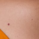 경화반점 이미지