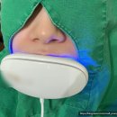 블랑쉬에 | 강남 블랑쉬 치과 무삭제 라미네이트 내돈내산 부착 후기