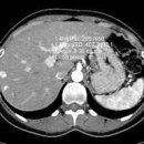 간 컴퓨터 단층촬영[liver computed tomography, liver CT] 이미지