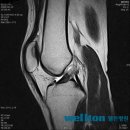 전방십자인대파열 수술후 운동복귀 시점은? 이미지