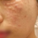 멍스터 | 원주 리쥬란힐러 내돈내산 후기, 엠보 자국 통증 멍