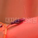 수지침(야간) 이미지
