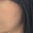 화장후 | [8일차, 9일차] 직장인 얼굴 편평사마귀 제거 후 화장 내돈내산 후기(완결편/회복 과정 사진 있음)