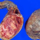 남성 생식기 ㅡ악성혼합생식세포종, Malignant mixed germ cell tumor 이미지