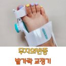 무지외반증 발가락 교정기 효과 후기 에버바디