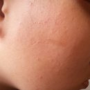 구성에이엔씨 | [메디션] 구하라박스★사용후기 여드름 빨리 없애는 법! 여드름화장품추천!